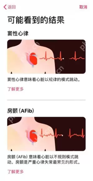 Apple Watch心电图有哪些检测结果