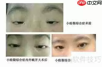 儿童近视眼的症状表现