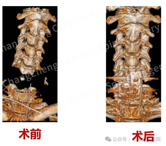 我国医生极限挑战救回“身首离断”患者，首创“卫星钢板”固定技术