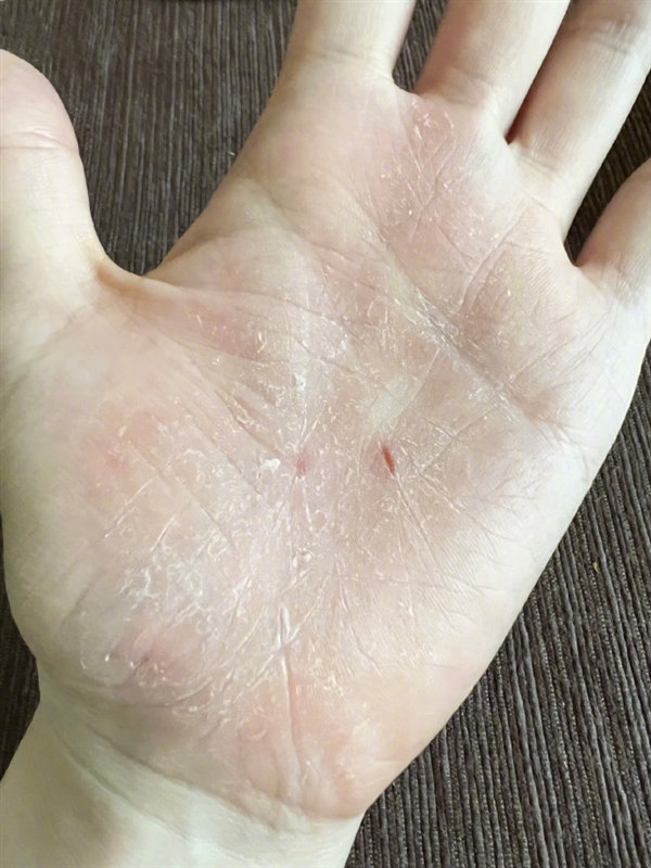 张靓颖自曝体检查出营养不良：额头血管莫名突起