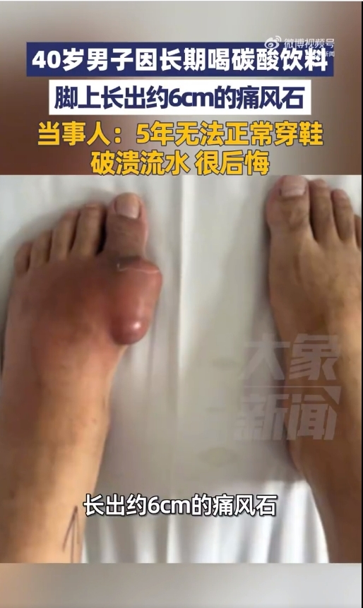 40岁男子因长期喝碳酸饮料