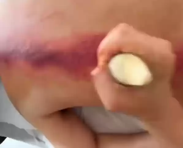 三甲医生回应易烊千玺刮痧高烧：洗澡后水湿寒邪侵入身体