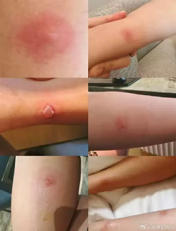 亚朵酒店住客称遭虫咬10处伤口 前台经理：天气炎热 很多事情没办法 赔偿尚未达成一致