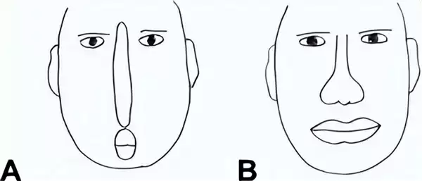 荷兰女子患罕见疾病 看到的人脸会扭曲为龙脸