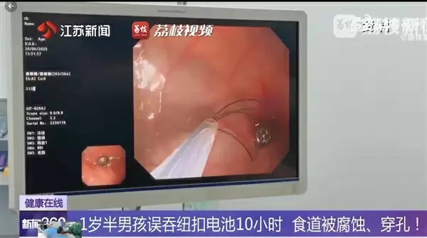 幼儿误吞电池10小时致终身残疾 医生提醒：纽扣电池卡在食道太骇人