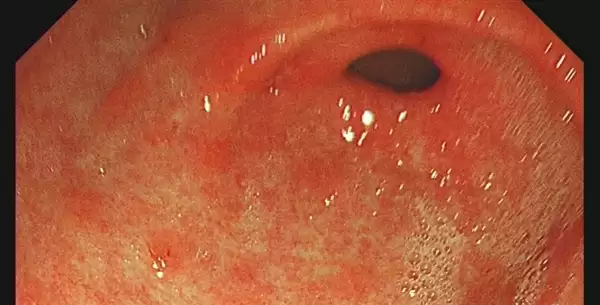 2个人中就有1人感染:医生让查幽门螺旋杆菌是真的想救你!