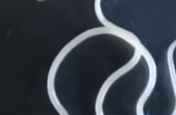 11岁男孩感染寄生虫瘦到15公斤：治疗排出一条13厘米长蛔虫