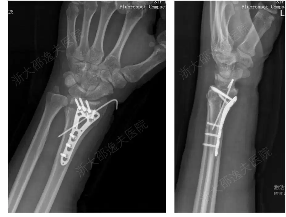 打一针就能治疗粉碎性骨折,浙大团队研发出全球首款“骨胶水”