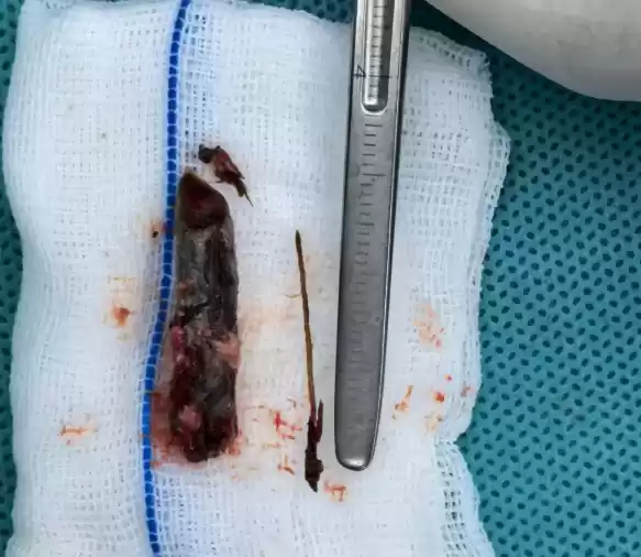 男子鼻痛18年疑骨瘤 开刀取出3cm树枝