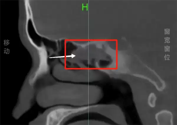 男子鼻痛18年疑骨瘤 开刀取出3cm树枝