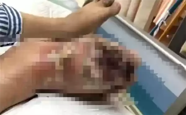 险些截肢!男子每天喝3罐可乐痛风石撑破皮肉 伤口溃烂巨大