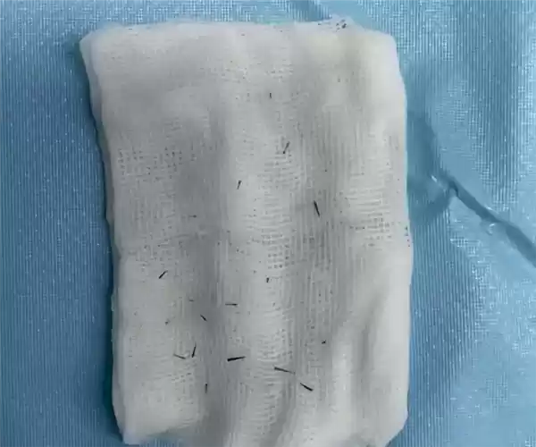 男子左眼扎入19根刺 医生紧急提醒：每年9月高发