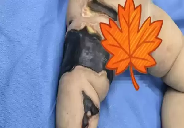 女婴遭虫咬多次抢救全身换血:诊断为脓毒血症 多器官衰竭