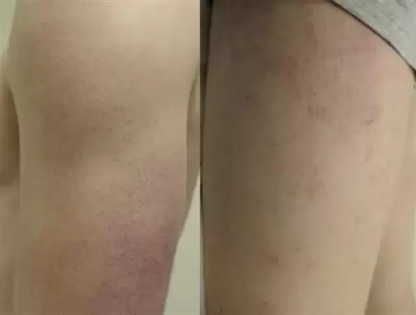 快住手！皮肤上的这些小颗粒真不是痘痘：别抠 也别随便用药