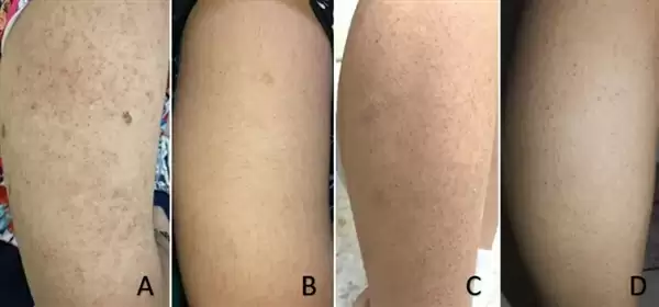 快住手！皮肤上的这些小颗粒真不是痘痘：别抠 也别随便用药