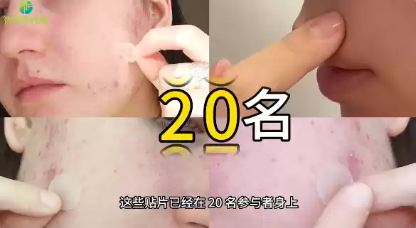 韩国开发出一种智能贴片:3D打印形成 7天内可消除青春痘