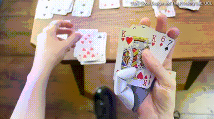 男子天生缺少拇指