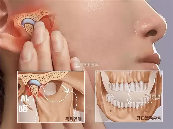 00后女生一觉醒来无法张嘴:确诊“TM D”