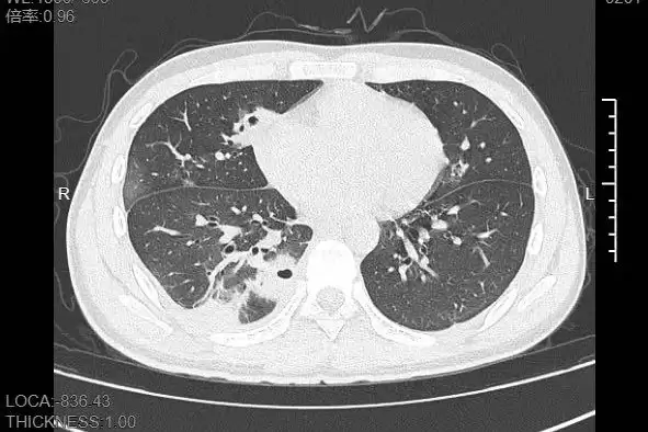 20岁男生挤了颗脸上的痘:肺被啃出10多个洞!