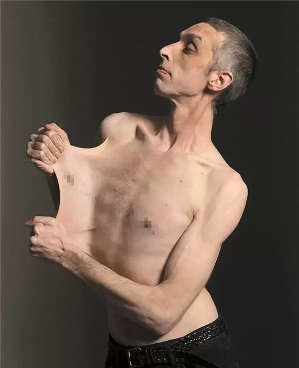 世界上皮肤最有“弹性”的男子 看完可能整个人都不好了