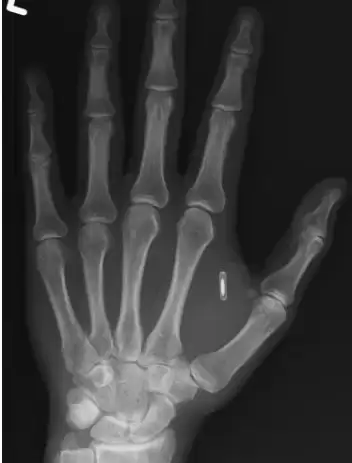 男子手部植入芯片后忘记密码，只能靠‘暴力破解’