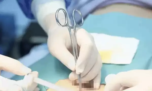 湖北男子20年酗酒难戒,新型戒酒芯片植入术显效