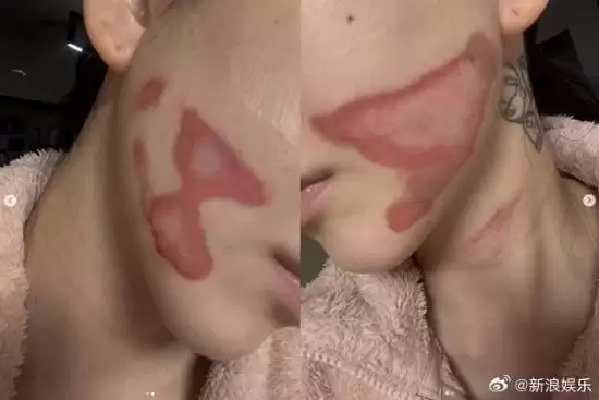 烧得太惨烈！韩国女星做医美竟然导致面度烧伤