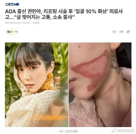 烧得太惨烈！韩国女星做医美竟然导致面度烧伤