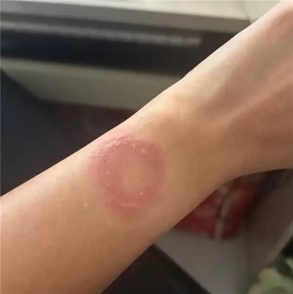 苹果Apple Watch灼伤手腕！更痛的是心寒：维权半年处处碰壁