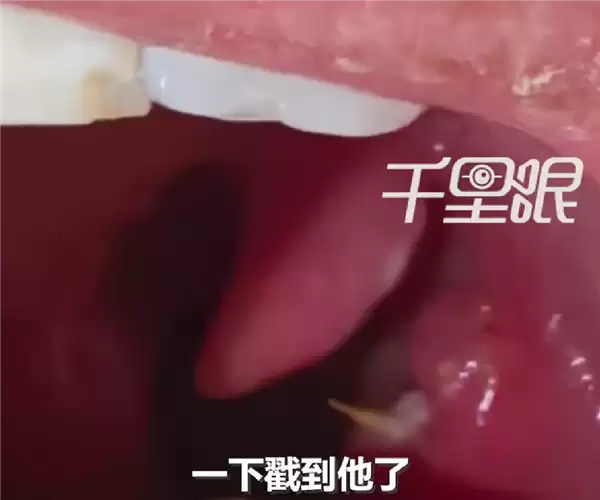 男子竹签卡喉误以为刀片嗓：吃8天药越吃越严重